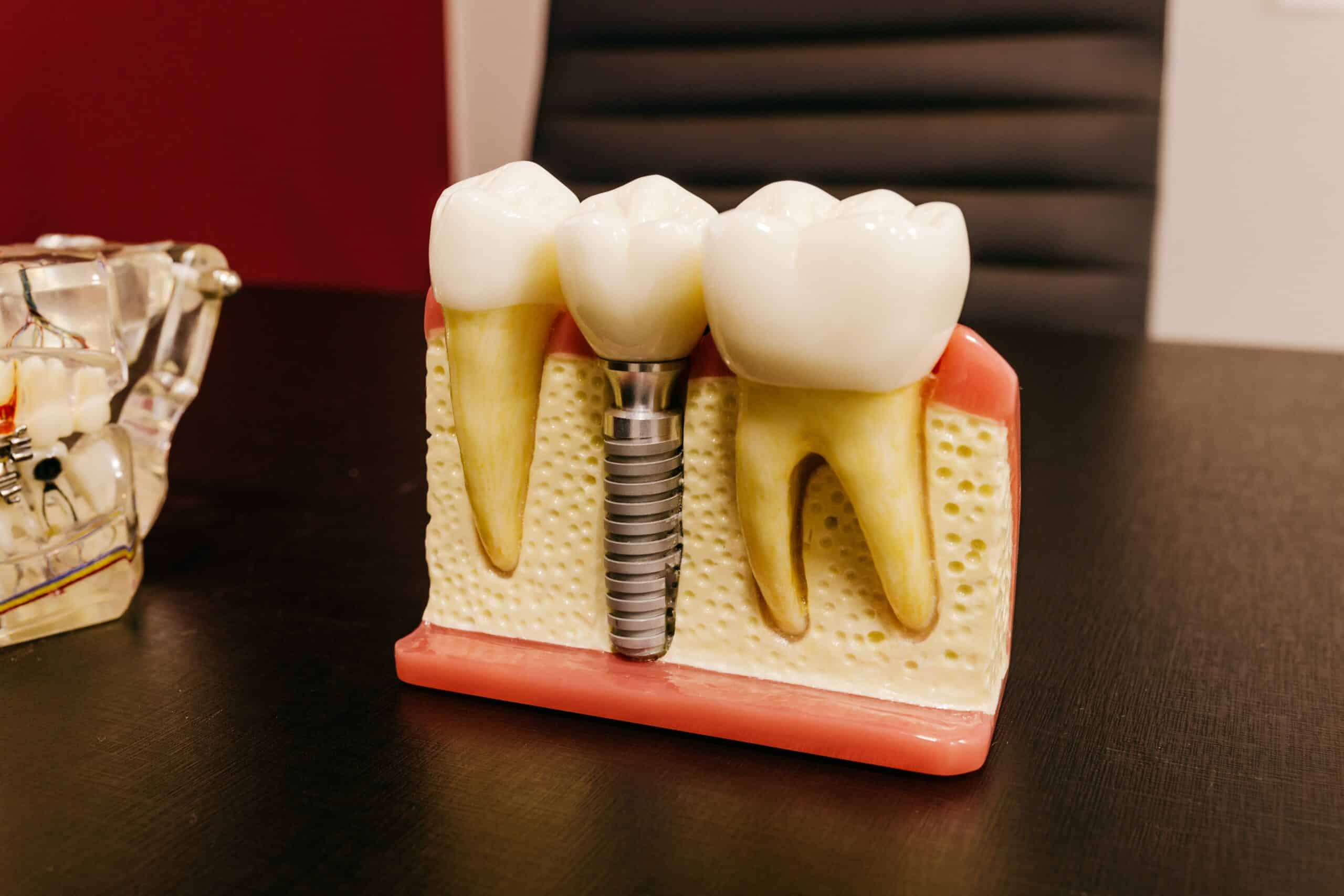 Dental Implants in Bakersfield CA Bakersfield Smile Design