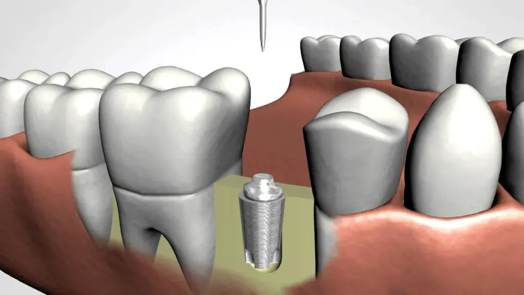 dental implants