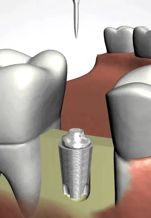 Can You Get Dental Implants If You Have Bone Loss? What Patients Should Know 9 dental implants
