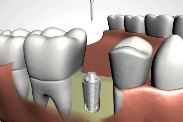 Can You Get Dental Implants If You Have Bone Loss? What Patients Should Know 2 dental implants