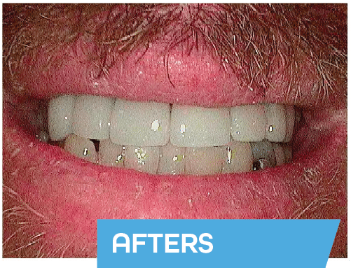 dental implants bakersfield david afters david - Best Cosmetic and General Dentistry In Bakersfield