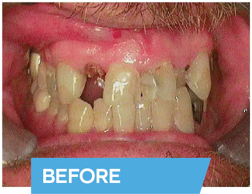 dental implants bakersfield david before afters david - Best Cosmetic and General Dentistry In Bakersfield