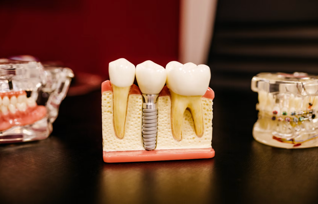 dental implants