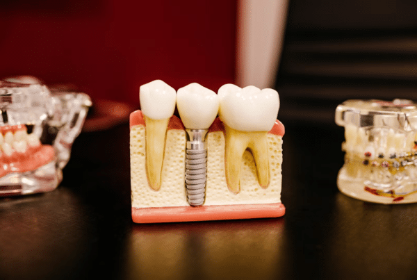 dental implants