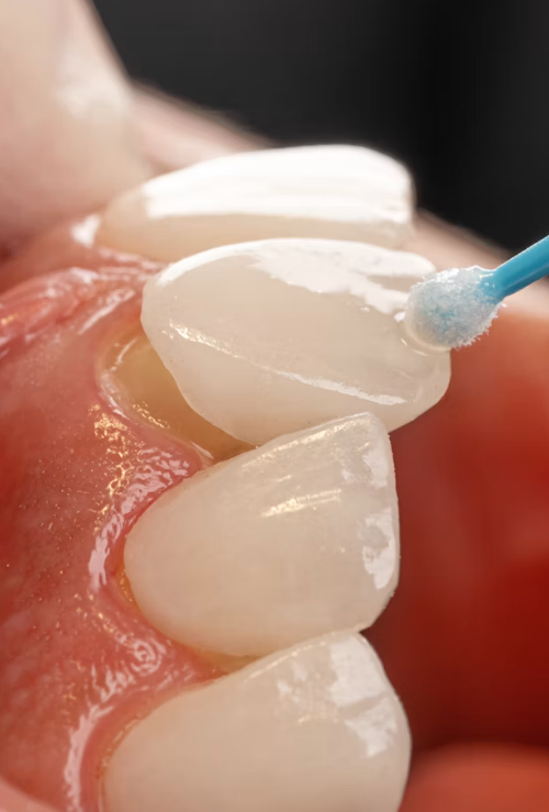 How Long Do Porcelain Veneers Last and What Can Shorten Their Lifespan 9 porcelain veneers