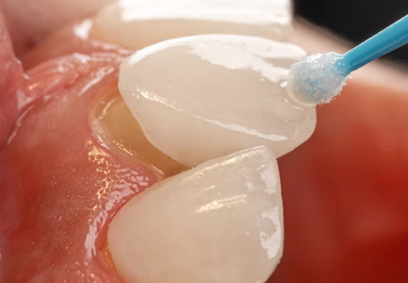 How Long Do Porcelain Veneers Last and What Can Shorten Their Lifespan 8 porcelain veneers