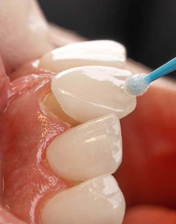 How Long Do Porcelain Veneers Last and What Can Shorten Their Lifespan 4 porcelain veneers