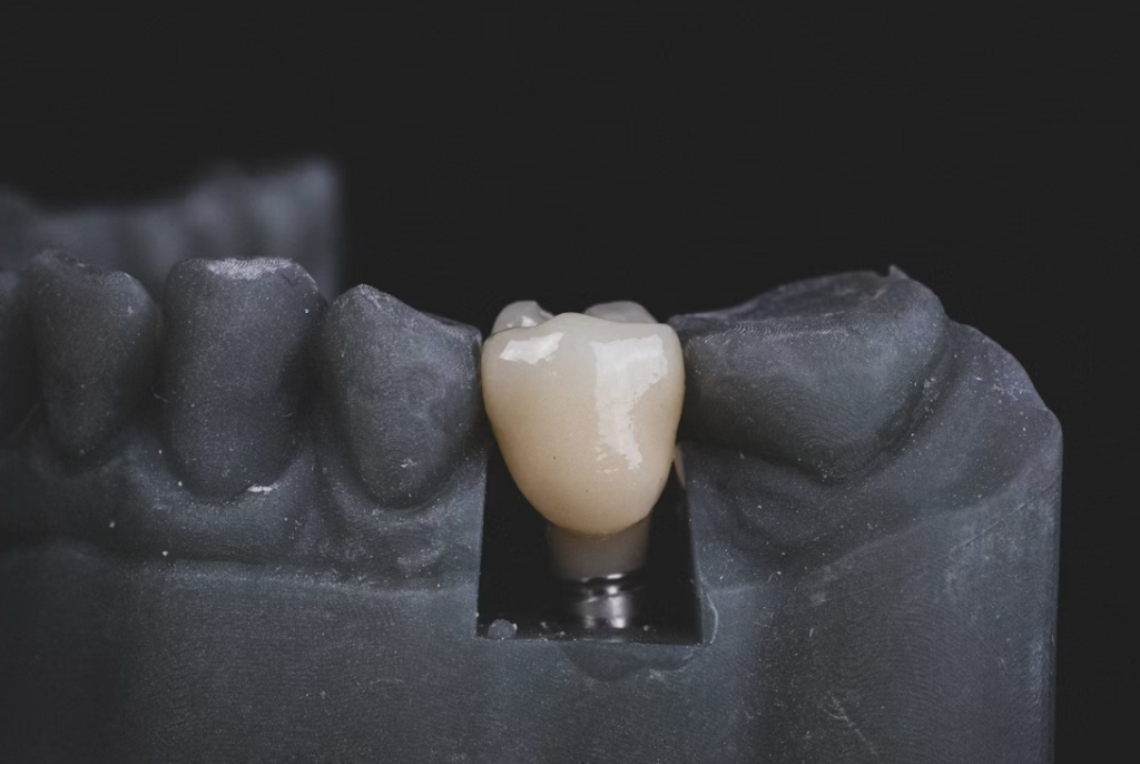 What Happens to Your Jawbone When You Leave a Missing Tooth Untreated 3 jawbone missing tooth