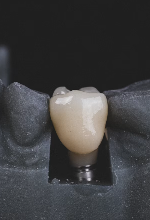 What Happens to Your Jawbone When You Leave a Missing Tooth Untreated 7 jawbone missing tooth