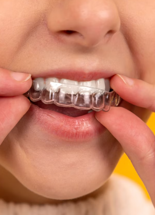Invisalign vs. Braces for Adults: Which One Actually Fits Your Life 5 invisalign