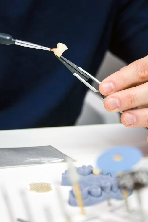 The Real Difference Between a Dental Crown and a Veneer and How to Know Which One You Need 4 dental crown