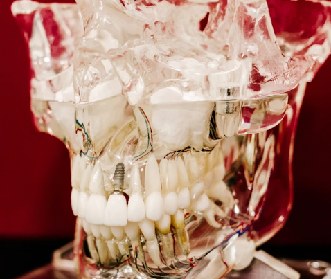 How Bone Grafting Makes Dental Implants Possible for Patients Who Were Told They Did Not Qualify 1 bone grafting